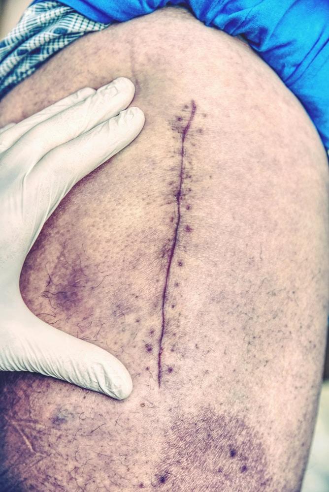  Law firm in Chicago handling severe nursing home injury lawsuits 