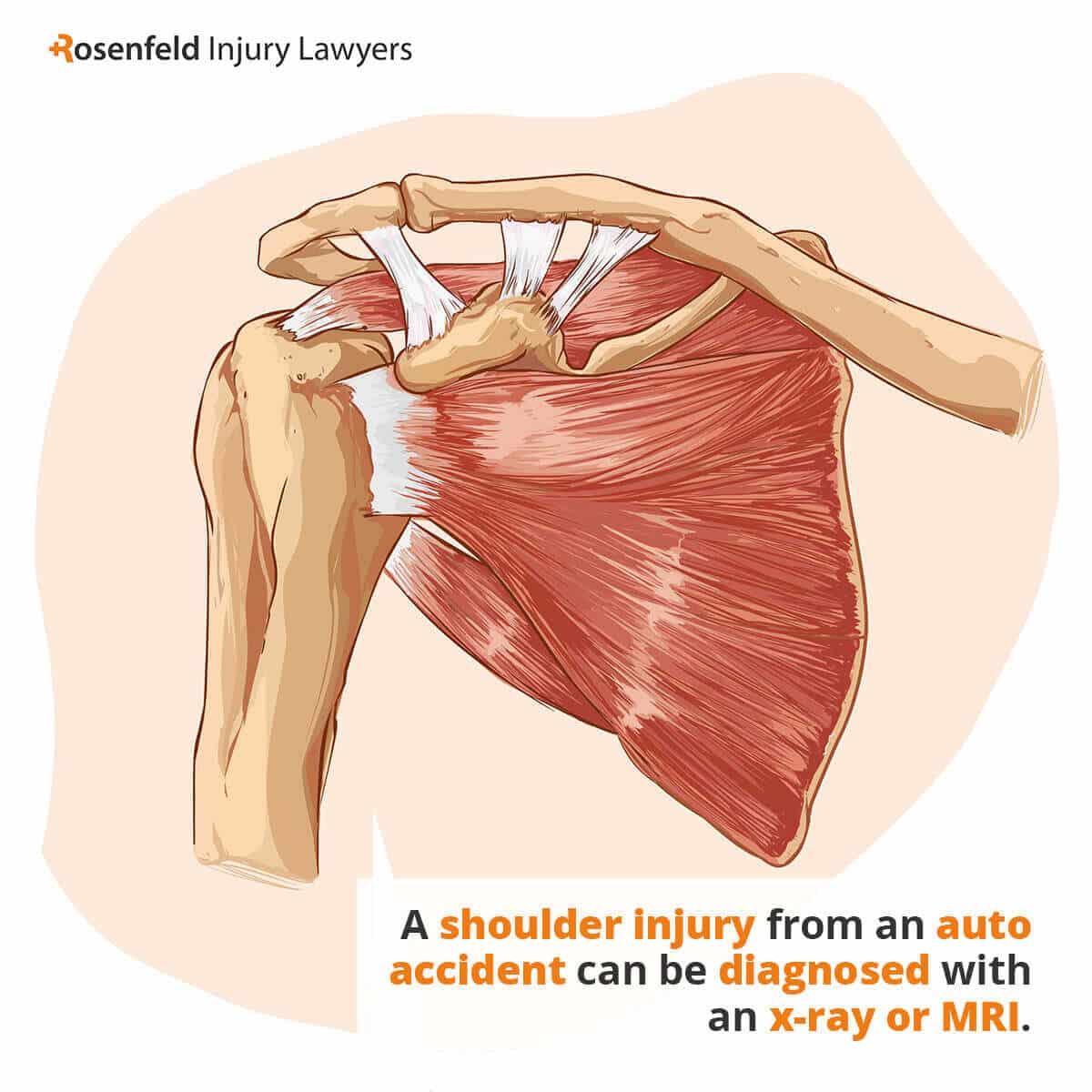 A shoulder injury from an auto accident can be diagnosed with an x-ray or MRI.