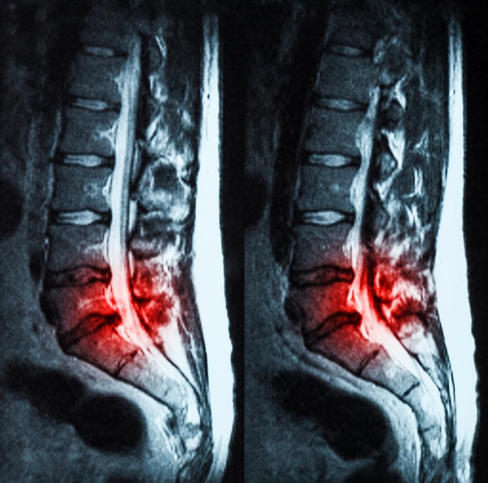 Chicago herniated disc lawyer explains how steroid injections impact settlements.