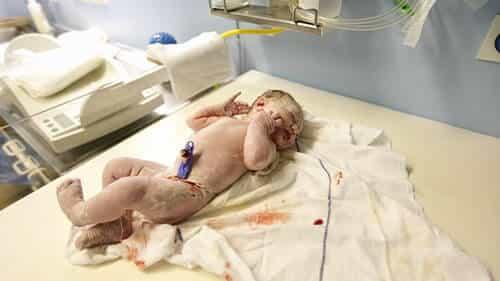 low-apgar-score-birth-injury-lawsuit