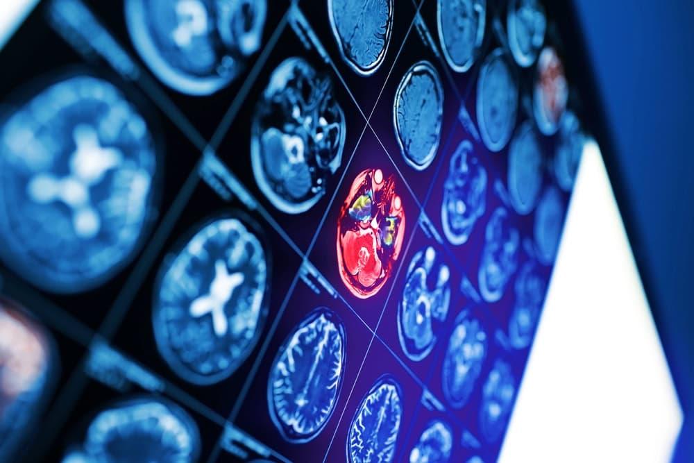Brain bleed following a traumatic car accident.
