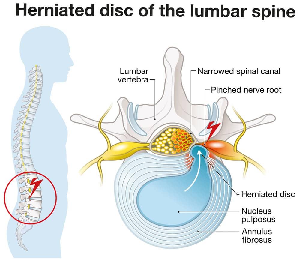 An attorney explains the role of physical therapy in herniated disc claims.