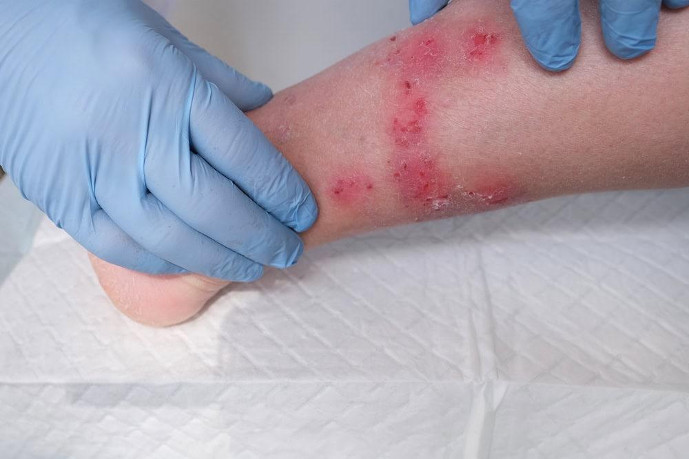 Legal representation for scalding and hot water burns in Chicago nursing homes