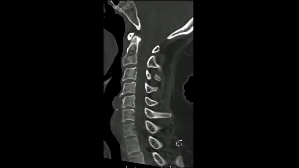 Chicago attorney focused on herniated disc settlements after auto accidents.