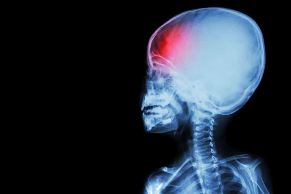 Personal Injury Settlements for Minors
