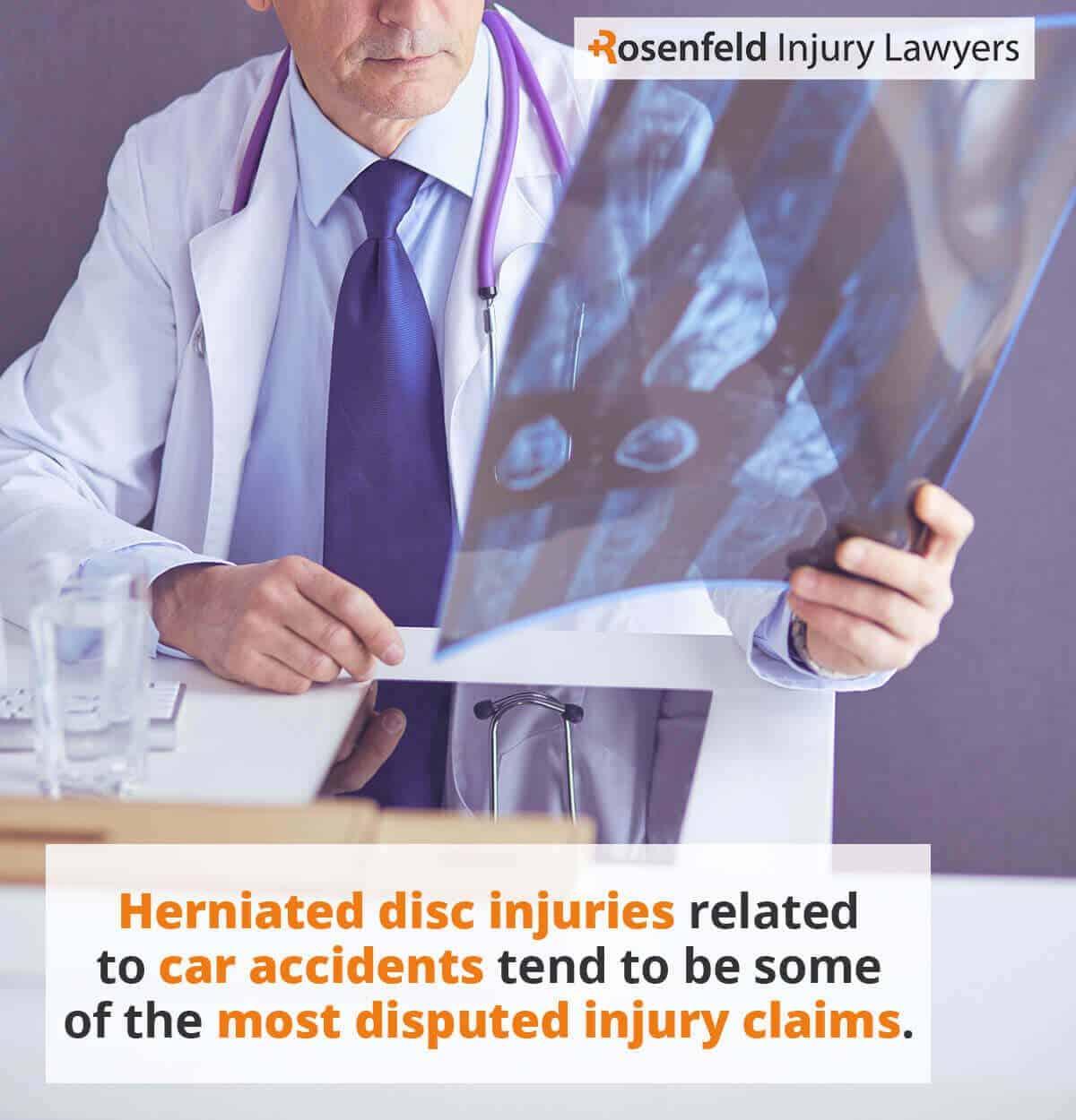 Herniated disc from car accident settlement amounts and sample cases.