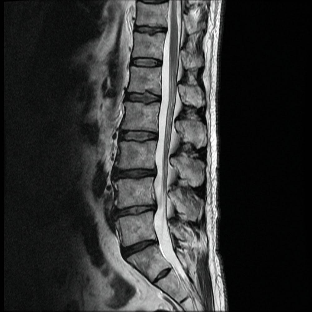 Illinois lawyer handling herniated disc cases from car accidents.