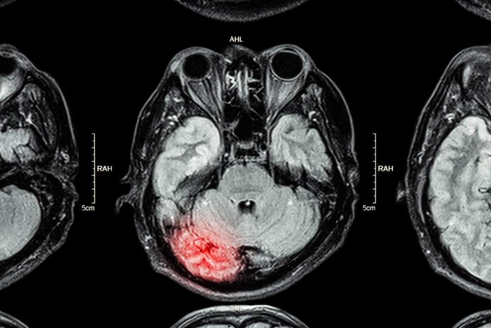 Compassionate Rockford lawyer assisting victims of brain injury and their families.