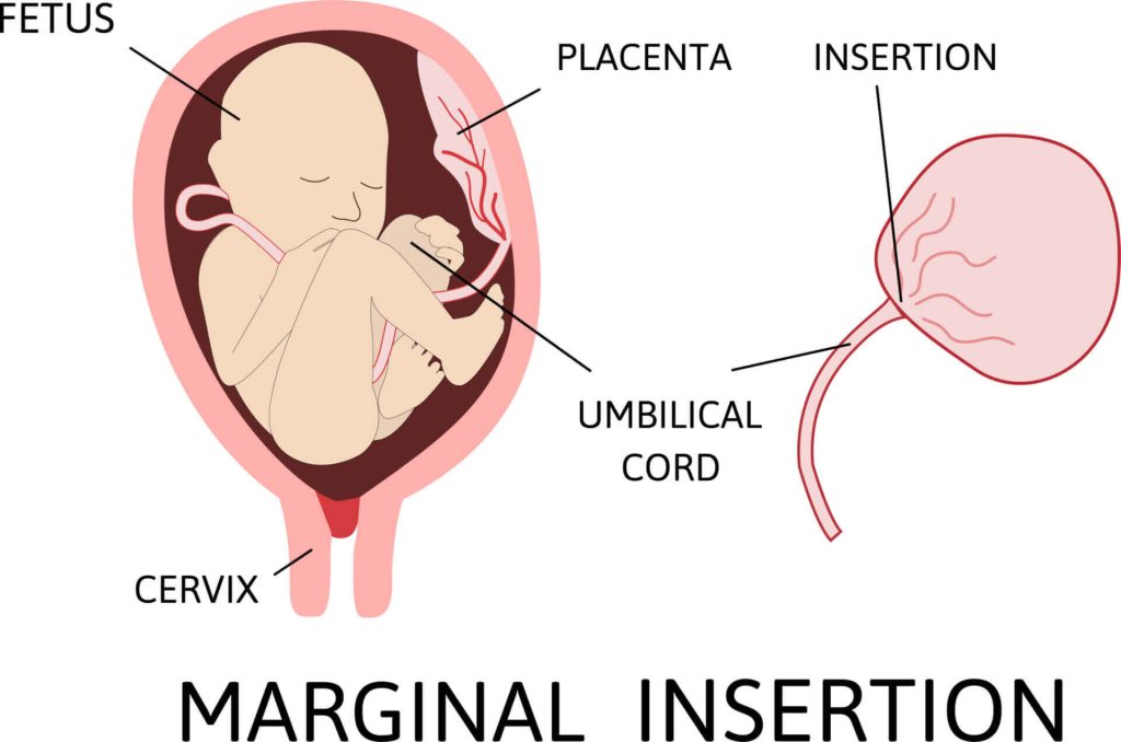 Birth Injuries from Marginal Cord Insertion